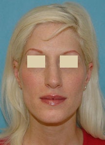 Rhinoplasty and Septoplasty