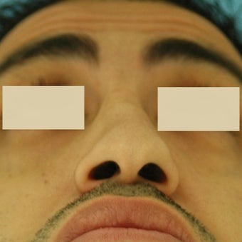Rhinoplasty, Septoplasty