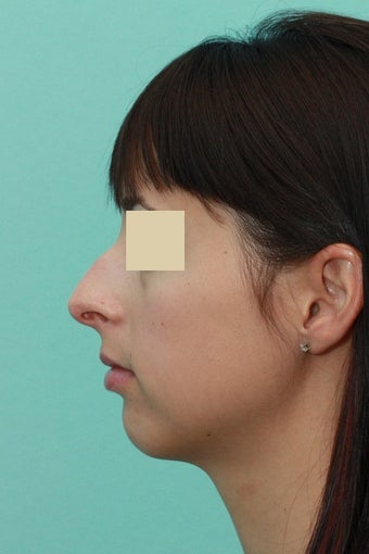 Open Septorhinoplasty