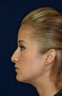 Rhinoplasty and Septoplasty