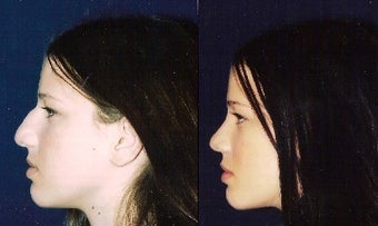 Septoplasty