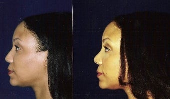 Rhinoplasty and Septoplasty