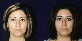 Rhinoplasty and Septoplasty