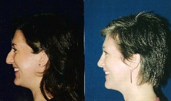 Rhinoplasty and Septoplasty