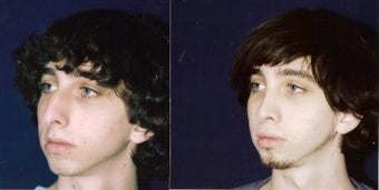 Rhinoplasty and Septoplasty