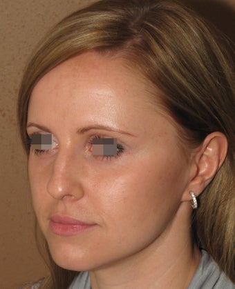 rhinoplasty/nose job