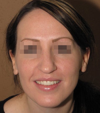 Septoplasty, nose job rhinoplasty