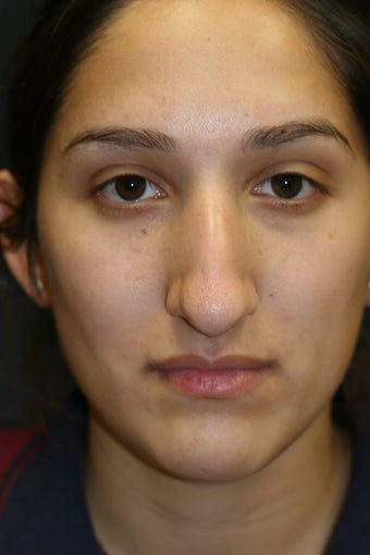 Rhinoplasty and Septoplasty