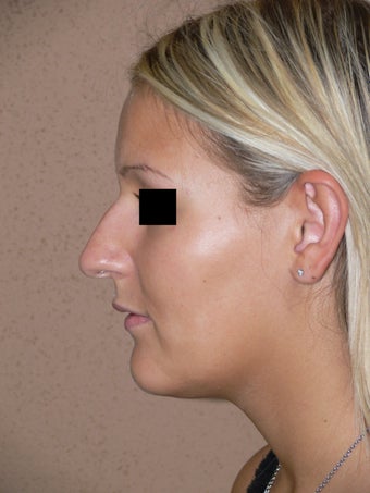 Nose job - rhinoplasty