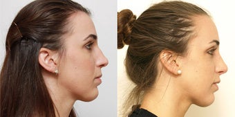 Septoplasty with rhinoplasty