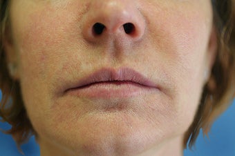 Silicone Microdroplets for Lip Augmentation