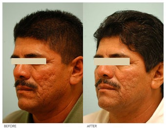 Acne Scarring Correction