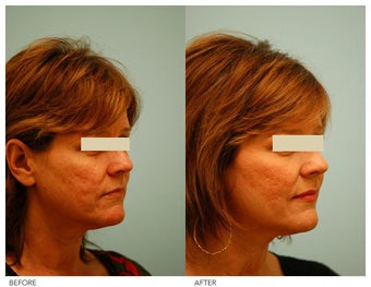 Acne Scarring Correction