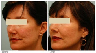 Acne Scarring Correction