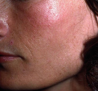 Facial Volumizing