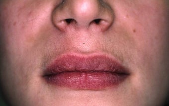 Lip Augmentation