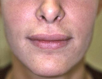 Lip Augmentation with Liquid Injectable Silicone