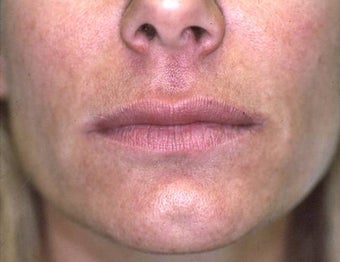 Lip Augmentation with Liquid Injectable Silicone