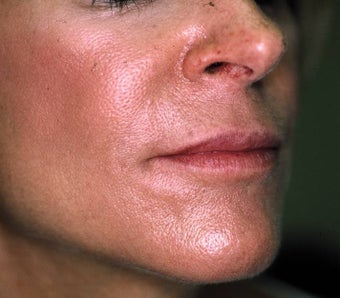 Correction of Facial Aging Grooves