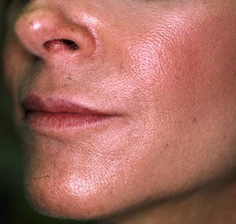 Correction of Facial Aging Grooves