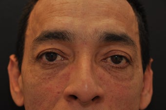 Silicone injections