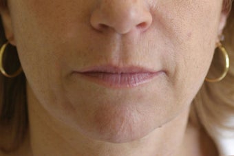 Lip Augmentation with Silicone