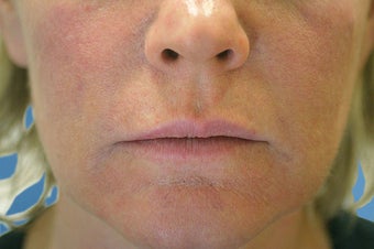 Silicone Microdroplets for Lip Augmentation