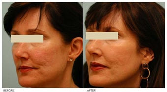 Acne Scarring Correction