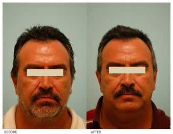 Acne Scarring Correction