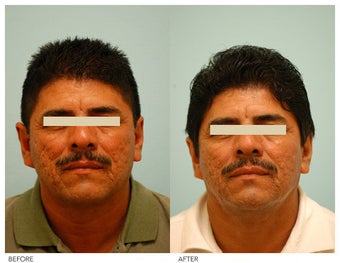 Acne Scarring Correction