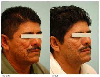 Acne Scarring Correction