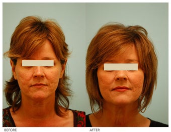 Acne Scarring Correction