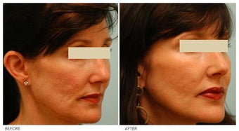 Acne Scarring Correction