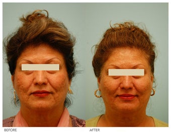 Acne Scarring Correction