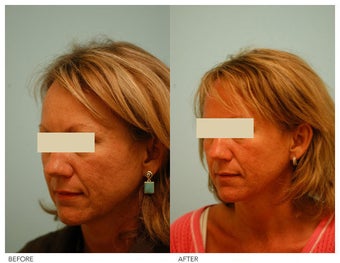 Acne Scarring Correction