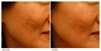 Acne Scarring Correction