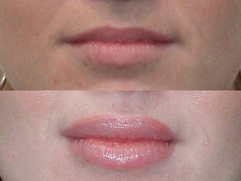 Lip Augmention with Silicone