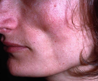 Facial Volumizing