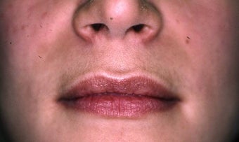 Lip Augmentation