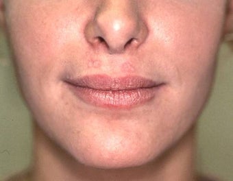 Lip Augmentation with Liquid Injectable Silicone