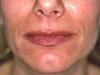 Lip Augmentation with Liquid Injectable Silicone