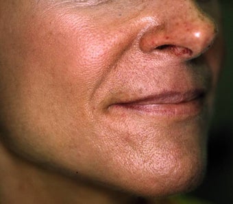 Correction of Facial Aging Grooves