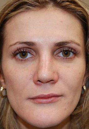 Silikon-1000 for lip augmentation and non-surgical nose job with IPL PhotoFacial