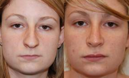 Rhinoplasty and Lip Enhancement with Silikon-1000