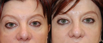 Silikon-1000 to correct lower eyelid irregularities after blepharoplasty
