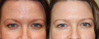 Non-Surgical Facial Rejuvenation with BOTOX Cosmetic and Silikon-1000