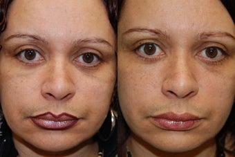 Silikon-1000, Permanent Injectable Filler for Lower Eyelid Bags