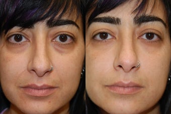 Silikon-1000, Injectable Filler treatment for lower eyelid "bags" and naso-labial folds.