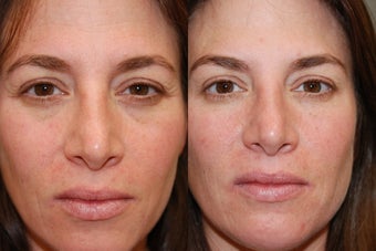 Non-Surgical Facial Rejuvenation with Silikon-1000 and Botox
