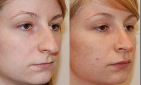 Rhinoplasty and Lip Augmentation with Silikon-1000
